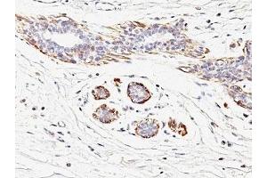 Formalin-fixed, paraffin-embedded human breast carcinoma stained with SMMHC antibody (MYH11/923). (MYH11 Antikörper)