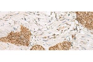 Immunohistochemistry of paraffin-embedded Human esophagus cancer tissue using PSPC1 Polyclonal Antibody at dilution of 1:30(x200)