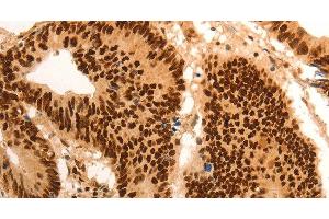 Immunohistochemistry of paraffin-embedded Human colon cancer tissue using E2F7 Polyclonal Antibody at dilution 1:60 (E2F7 Antikörper)