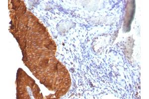 Formalin-fixed, paraffin-embedded human Bladder Carcinoma stained with Cytokeratin 19 Monoclonal Antibody (SPM561) (Cytokeratin 19 Antikörper)