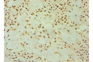 Immunohistochemistry of paraffin-embedded human breast cancer using ABIN7149891 at dilution of 1:100 (DKK4 Antikörper  (AA 19-224))