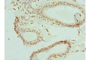 Immunohistochemistry of paraffin-embedded human breast cancer using ABIN7152086 at dilution of 1:100 (ELF1 Antikörper  (AA 1-210))
