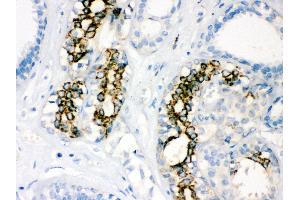 Anti-SOD2 Picoband antibody, IHC(P) IHC(P): Human Mammary Cancer Tissue (SOD2 Antikörper  (C-Term))