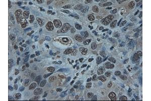 Immunohistochemical staining of paraffin-embedded Carcinoma of liver using anti-ID2 (ABIN2452680) mouse monoclonal antibody. (Id2 Antikörper)