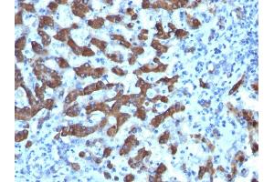 Formalin-fixed, paraffin-embedded human Hepatocellular Ca stained with CPS1 Monoclonal Antibody (CPS1/1022). (CPS1 Antikörper)
