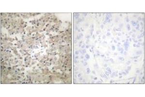Immunohistochemistry analysis of paraffin-embedded human lung carcinoma, using Tryptophan Hydroxylase (Phospho-Ser260) Antibody. (Tryptophan Hydroxylase 1 Antikörper  (pSer260))