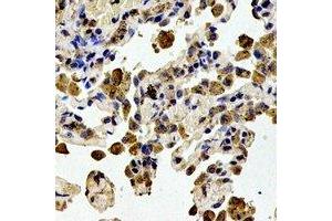 Immunohistochemical analysis of STMN1 (pS38) staining in human lung cancer formalin fixed paraffin embedded tissue section. (Stathmin 1 Antikörper  (N-Term, pSer38))