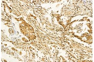 ABIN6259767 and ABIN6272861 at 1/100 staining Human pancreatic cancer by IHC-P. (ADAM12 Antikörper  (N-Term))