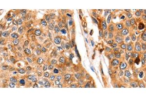 Immunohistochemistry of paraffin-embedded Human esophagus cancer tissue using Cathepsin B Polyclonal Antibody at dilution 1:140 (Cathepsin B Antikörper)