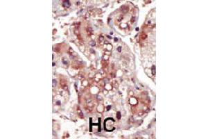 Formalin-fixed and paraffin-embedded human hepatocellular carcinoma tissue reacted with MAP2K2 polyclonal antibody  , which was peroxidase-conjugated to the secondary antibody, followed by DAB staining. (MEK2 Antikörper  (AA 262-292))