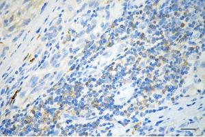Immunohistochemistry was performed on paraffin-embedded human glioblastoma using PKC alpha antibody (ABIN7799989), 1:200).