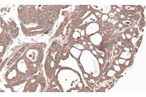 IHC-P Image Immunohistochemical analysis of paraffin-embedded Gastric CA N87 xenograft, using MMP12, antibody at 1:100 dilution. (MMP12 Antikörper)