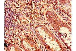 Immunohistochemistry of paraffin-embedded human colon cancer using ABIN7157408 at dilution of 1:100