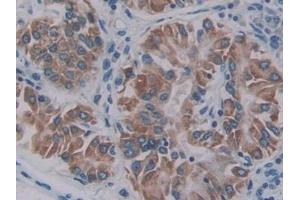 Detection of PKBb in Human Lung cancer Tissue using Polyclonal Antibody to Protein Kinase B Beta (PKBb)