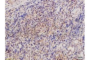 Formalin-fixed and paraffin embedded human osteosarcoma tissue labeled with Anti-Twist Polyclonal Antibody , and DAB staining (TWIST1, TWIST2 (AA 71-170) Antikörper)
