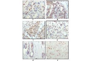 Immunohistochemical analysis of paraffin-embedded human esophageal squamous cell carcinoma (A), colon adenocarcinoma (B), liver carcinoma (C), skin carcinoma (D), breast ductal tumor (E) and brain tumor (F), showing nuclear localization using RSK1 mouse mAb with DAB staining. (RPS6KA1 Antikörper)