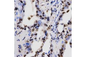 Immunohistochemistry of paraffin-embedded human lung cancer tissue using H3K4me2 antibody at dilution of 1:200 (x400 lens). (Histone 3 Antikörper  (H3K4me2))