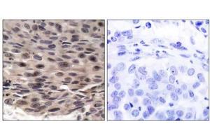 Immunohistochemical analysis of paraffin-embedded human breast carcinoma tissue using FKHRL1 (phospho-Ser253) antibody (E011222). (eIF4EBP1 Antikörper  (pThr36))