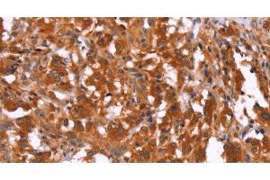 Immunohistochemistry of paraffin-embedded Human thyroid cancer using HAS1 Polyclonal Antibody at dilution of 1:30 (HAS1 Antikörper)