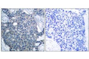 Immunohistochemical analysis of paraffin-embedded human breast carcinoma tissue using Stathmin 1 (Ab-24) antibody (E021217). (Stathmin 1 Antikörper)