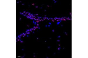 Immunofluorescence of paraffin embedded human breast cancer using CITED4 (ABIN7073356) at dilution of 1:2200 (400x lens) (CITED4 Antikörper)