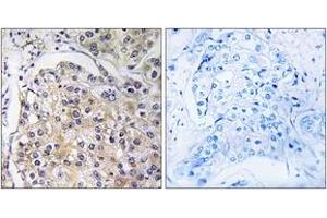 Immunohistochemistry analysis of paraffin-embedded human breast carcinoma tissue, using GPR116 Antibody. (G Protein-Coupled Receptor 116 Antikörper  (AA 1121-1170))