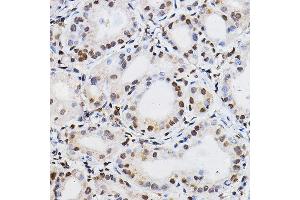 Immunohistochemistry of paraffin-embedded human thyroid cancer using PER2 Rabbit pAb (ABIN6131889, ABIN6145450, ABIN6145452 and ABIN6217063) at dilution of 1:100 (40x lens). (PER2 Antikörper  (AA 1-150))