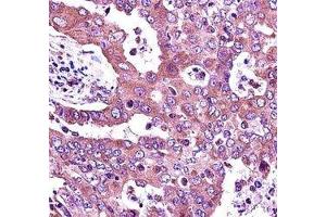 JAK2 antibody immunohistochemistry analysis in formalin fixed and paraffin embedded human lung adenocarcinoma. (JAK2 Antikörper  (AA 666-694))