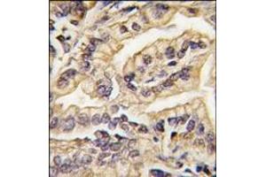 Formalin-fixed and paraffin-embedded human lung carcinoma tissue reacted with CSF1R Antibody (C-term), which was peroxidase-conjugated to the secondary antibody, followed by DAB staining. (CSF1R Antikörper  (C-Term))
