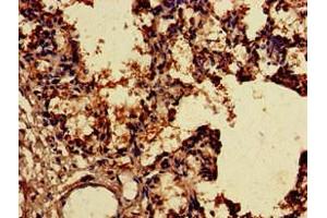 Immunohistochemistry of paraffin-embedded human lung tissue using ABIN7170356 at dilution of 1:100 (SNX15 Antikörper  (AA 144-321))