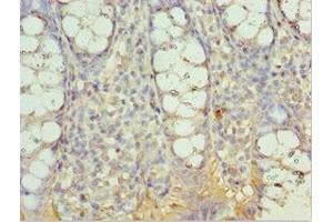 Immunohistochemistry of paraffin-embedded human colon cancer using ABIN7143999 at dilution of 1:100 (AIMP2 Antikörper  (AA 141-320))