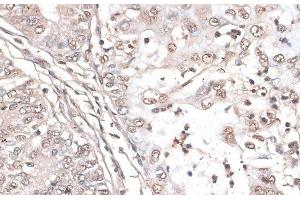 Immunohistochemistry of paraffin-embedded Human endometrium cancer using MEF2C Polyclonal Antibody at dilution of 1:100 (40x lens). (MEF2C Antikörper)
