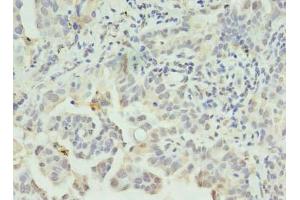 Immunohistochemistry of paraffin-embedded human lung cancer using ABIN7146041 at dilution of 1:100 (CLEC1A Antikörper  (AA 74-280))