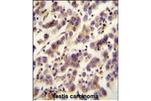 OR1J4 antibody (C-term) (ABIN655015 and ABIN2844648) immunohistochemistry analysis in formalin fixed and paraffin embedded human testis carcinoma followed by peroxidase conjugation of the secondary antibody and DAB staining. (OR1J4 Antikörper  (C-Term))