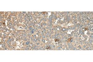 Immunohistochemistry of paraffin-embedded Human liver cancer tissue using CA11 Polyclonal Antibody at dilution of 1:45(x200) (CA11 Antikörper)