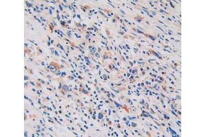IHC-P analysis of stomach cancer tissue, with DAB staining. (GLDC Antikörper  (AA 81-268))
