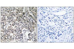 Immunohistochemistry analysis of paraffin-embedded human breast carcinoma tissue using USP19 antibody.