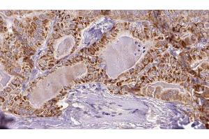 ABIN6273353 at 1/100 staining Human thyroid cancer tissue by IHC-P. (SLC7A11 Antikörper)