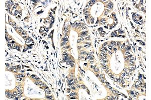 ABIN6264993 and ABIN6279791 at 1/100 staining Human pancreatic cancer by IHC-P. (Septin 11 Antikörper  (N-Term))