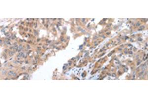 Immunohistochemistry of paraffin-embedded Human breast cancer tissue using COX7C Polyclonal Antibody at dilution of 1:40(x200) (COX7C Antikörper)