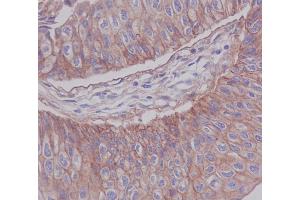 Immunohistochemical analysis of paraffin-embedded human blader cancer, using JAM1 Antibody. (Rekombinanter F11R Antikörper)