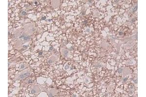DAB staining on IHC-P; Samples: Human Glioma Tissue) (PAI1 Antikörper  (AA 25-402))