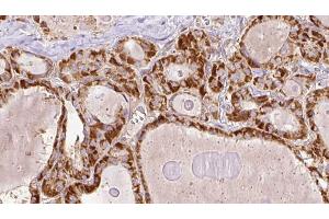 ABIN6267201 at 1/100 staining Human thyroid cancer tissue by IHC-P. (TRAF2 Antikörper  (pSer11))