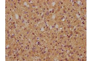 IHC image of ABIN7174981 diluted at 1:200 and staining in paraffin-embedded human glioma cancer performed on a Leica BondTM system. (Myosin XVIIIA Antikörper  (AA 1849-2054))