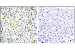 Immunohistochemistry analysis of paraffin-embedded human liver carcinoma tissue, using CHD4 Antibody.