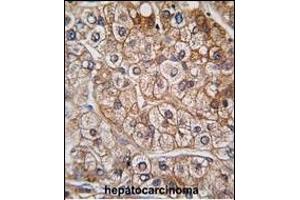 Formalin-fixed and paraffin-embedded human hepatocarcinoma tissue reacted with BR2 antibody (N-term), which was peroxidase-conjugated to the secondary antibody, followed by DAB staining. (BMPR2 Antikörper  (N-Term))