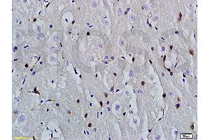 Formalin-fixed and paraffin embedded human hepatoma labeled with Anti-phospho-CDKN2A/p16-INK4a (Ser140) Polyclonal Antibody, Unconjugatedfollowed by conjugation to the secondary antibody and DAB staining (PIK3CA Antikörper  (pTyr317))