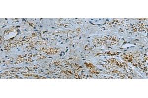 Immunohistochemistry of paraffin-embedded Human cervical cancer tissue using IL17RD Polyclonal Antibody at dilution of 1:40(x200) (IL17RD Antikörper)