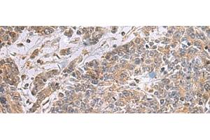 Immunohistochemistry of paraffin-embedded Human colorectal cancer tissue using UBTD1 Polyclonal Antibody at dilution of 1:25(x200) (UBTD1 Antikörper)