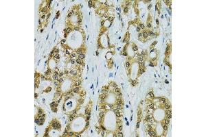 Immunohistochemistry of paraffin-embedded human rectal cancer using RPS7 antibody. (RPS7 Antikörper  (AA 1-194))